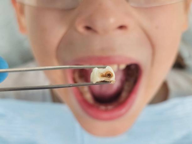 Best Emergency Treatment for Toothache in Newcastle, WA